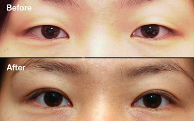 大小眼如何用超 声 波双眼 皮来矫正呢? 大小眼如何用超 声 波双眼 皮来矫正呢?