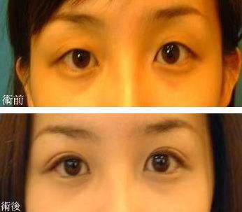 大小眼如何用超 声 波双眼 皮来矫正呢? 大小眼如何用超 声 波双眼 皮来矫正呢?