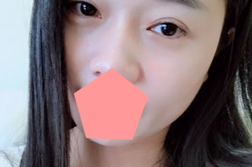 重庆超雅得梁杰做双眼 皮怎么样？看他用超 声 波双眼 皮修复失败双眼
