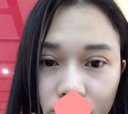 重庆超雅得梁杰做双眼 皮怎么样？看他用超 声 波双眼 皮修复失败双眼