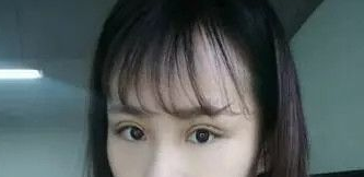 重庆超雅得梁杰做双眼 皮怎么样？看他用超 声 波双眼 皮修复失败双眼