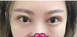 超声波双眼皮让真实的美丽绽放出来!860 超声波双眼皮让真实的美丽绽放出来!860