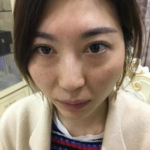 怎样去眼袋又快又好——超声波去眼袋手术365 怎样去眼袋又快又好——超声波去眼袋手术365