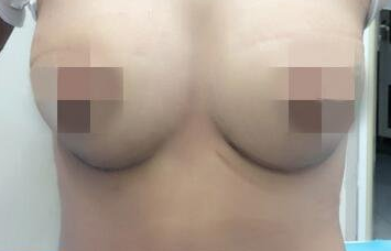 超 声 波自体脂肪丰胸个人案例分享，真实大乳！