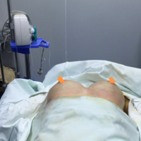 超声波自体脂肪丰胸改变了我的平胸586 超声波自体脂肪丰胸改变了我的平胸586