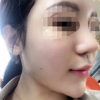 超声波自体脂肪丰胸改变了我的平胸586 超声波自体脂肪丰胸改变了我的平胸586