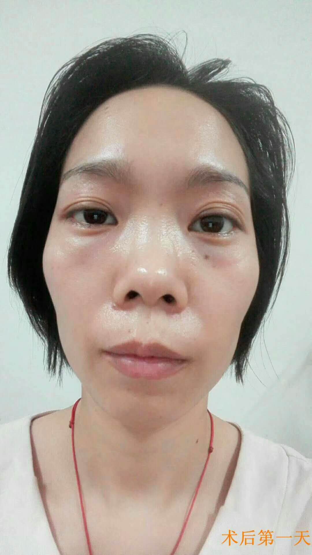超声波去眼袋让我妈的眼袋轻松没有了639 超声波去眼袋让我妈的眼袋轻松没有了639