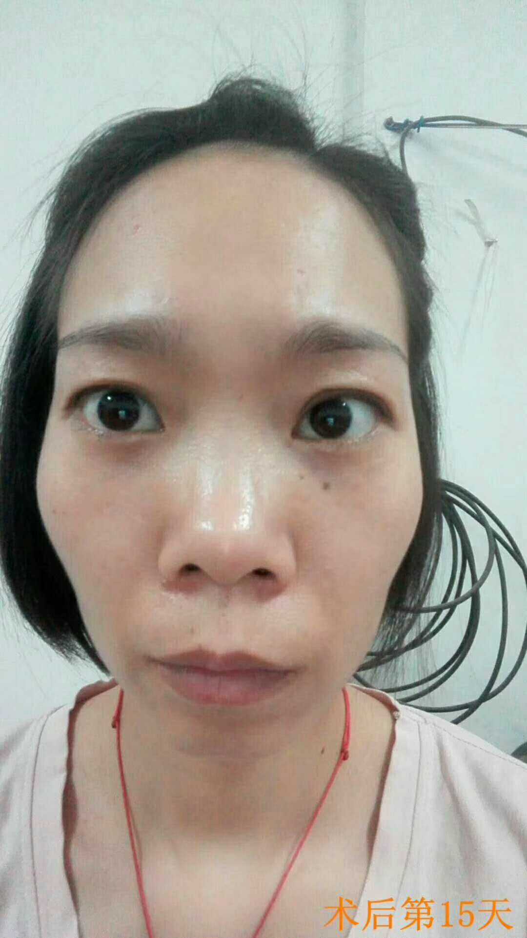 超声波去眼袋让我妈的眼袋轻松没有了639 超声波去眼袋让我妈的眼袋轻松没有了639