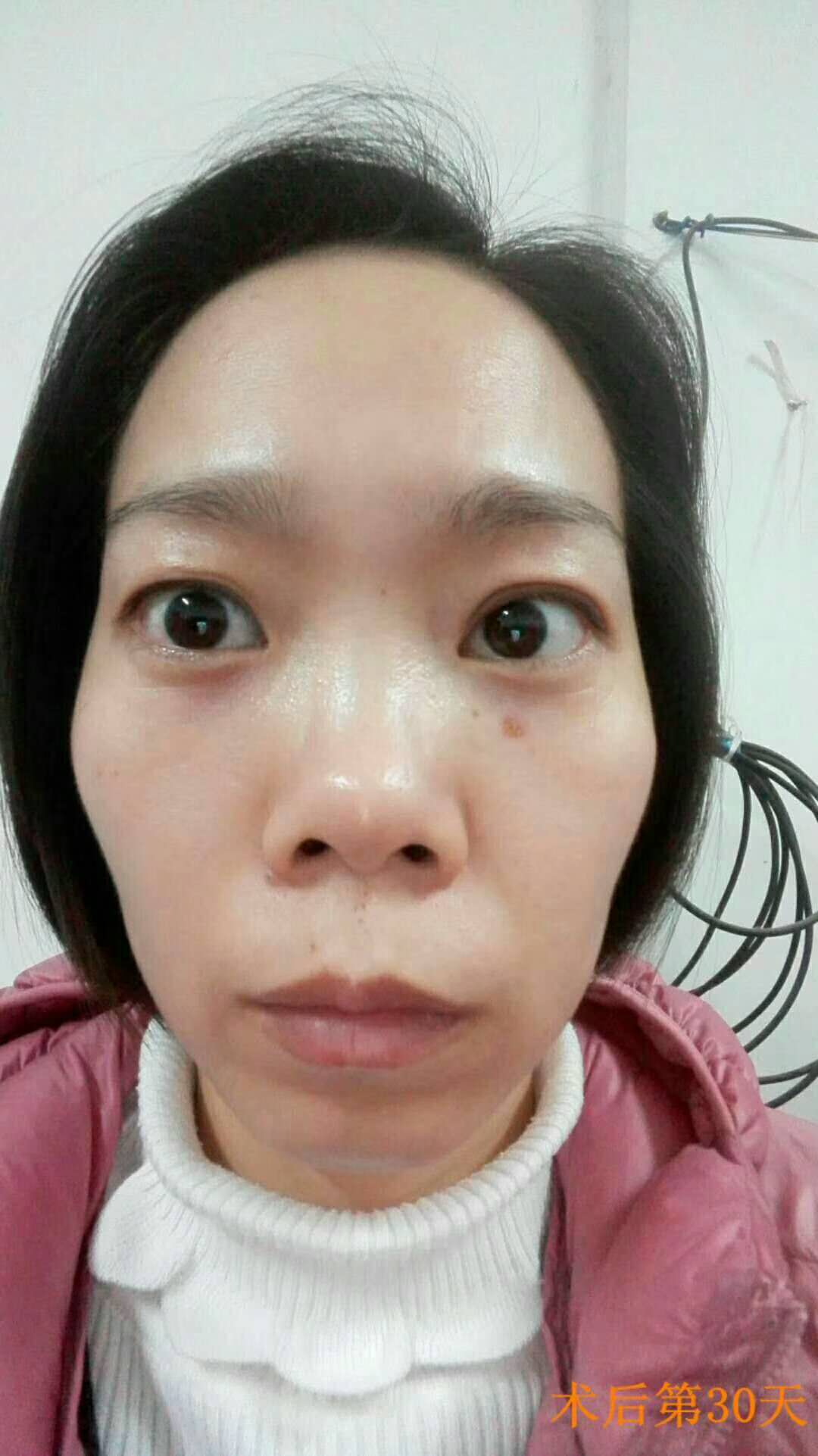 超声波去眼袋让我妈的眼袋轻松没有了639 超声波去眼袋让我妈的眼袋轻松没有了639