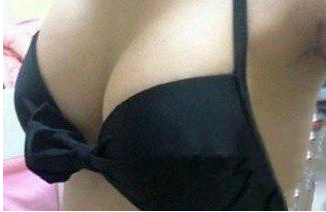做了自体脂肪丰胸以后轻松变成有着C罩杯的美女181