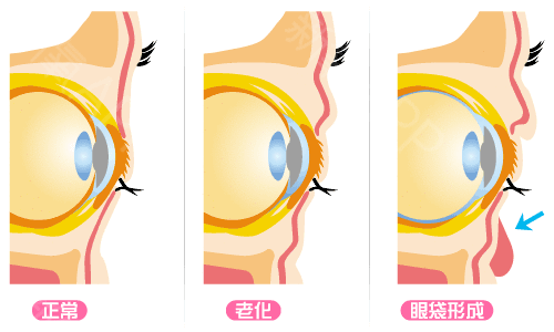熬夜加班长眼袋,超 声 波去眼袋帮程序员消除眼袋 熬夜加班长眼袋,超 声 波去眼袋帮程序员消除眼袋
