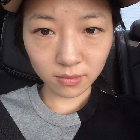 去眼袋手术还是做超声波去眼袋靠谱639 去眼袋手术还是做超声波去眼袋靠谱639