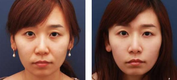 想要焕发年轻光彩?找超雅超 声 波面部提升 想要焕发年轻光彩?找超雅超 声 波面部提升