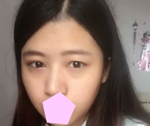 全切双眼 皮失败le怎么办？看超 声 波双眼 皮发明人如何解决！