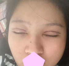 全切双眼 皮失败le怎么办？看超 声 波双眼 皮发明人如何解决！