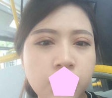 全切双眼 皮失败le怎么办？看超 声 波双眼 皮发明人如何解决！