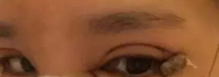 来看看小姐姐做的超声波双眼皮,真的不错哦。212 来看看小姐姐做的超声波双眼皮,真的不错哦。212