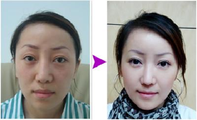 超 声 波面部提升帮wǒ早早抵御衰老