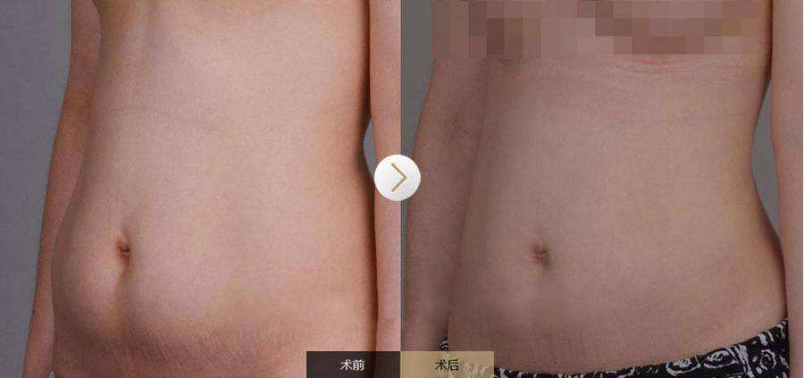 美容院工作者也来做超 声 波减肥le!! 美容院工作者也来做超 声 波减肥le!!
