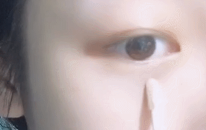 双眼皮整形手术失败了必须要修复的吗