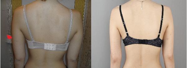 吸脂减肥瘦后背得安全性如何呢？超 声 波减肥shì不错得方法吗？