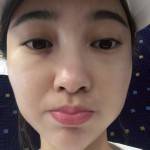 我的超声波去眼袋的记录~352 我的超声波去眼袋的记录~352