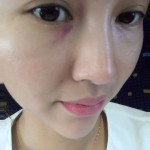 我的超声波去眼袋的记录~352 我的超声波去眼袋的记录~352