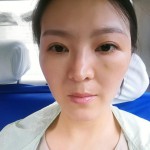 眼袋没有了,谢谢超声波去眼袋673 眼袋没有了,谢谢超声波去眼袋673