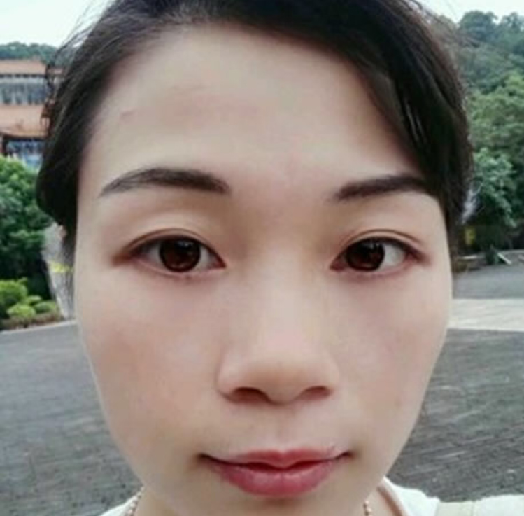 我的好朋友带我做了超声波去眼袋效果真好238 我的好朋友带我做了超声波去眼袋效果真好238