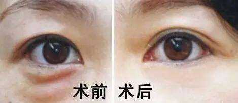 男士如何去眼袋呢?超声波去眼袋不错呢!835 男士如何去眼袋呢?超声波去眼袋不错呢!835