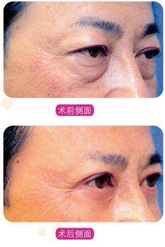 男士如何去眼袋呢?超声波去眼袋不错呢!835 男士如何去眼袋呢?超声波去眼袋不错呢!835