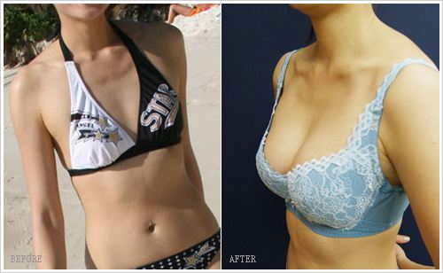 超声波自体脂肪丰胸手术让你也有天然巨乳!023 超声波自体脂肪丰胸手术让你也有天然巨乳!023