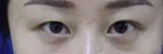 做了超声波双眼皮后,我的气质提升不少543 做了超声波双眼皮后,我的气质提升不少543
