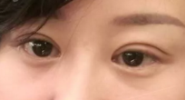 做了超声波双眼皮后,我的气质提升不少543 做了超声波双眼皮后,我的气质提升不少543
