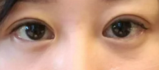 做了超声波双眼皮后,我的气质提升不少543 做了超声波双眼皮后,我的气质提升不少543