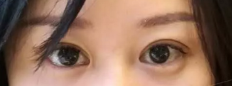 做了超声波双眼皮后,我的气质提升不少543 做了超声波双眼皮后,我的气质提升不少543
