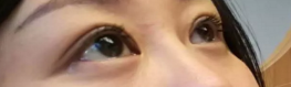 做了超声波双眼皮后,我的气质提升不少543 做了超声波双眼皮后,我的气质提升不少543