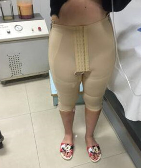 超声波减肥瘦大腿，看看这改变我大象腿的技术吧853