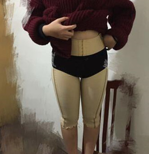 超声波减肥瘦大腿，看看这改变我大象腿的技术吧853