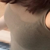 超声波自体脂肪丰胸——以前的内衣可以压箱底了250