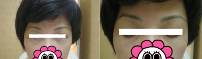 超声波去眼袋,不复发我信了015 超声波去眼袋,不复发我信了015