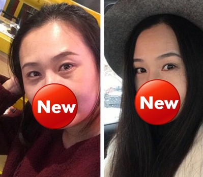 超声波去眼袋,轻轻松松去眼袋939 超声波去眼袋,轻轻松松去眼袋939