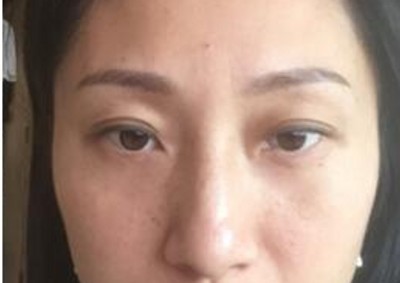 去眼袋,我选择了超声波去眼袋593 去眼袋,我选择了超声波去眼袋593