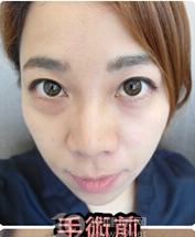 幼儿园园长小梁得超 声 波去眼袋分享 幼儿园园长小梁得超 声 波去眼袋分享