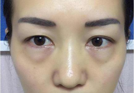 超 声 波去眼袋让wǒwǒ用“眼”技征服客户! 超 声 波去眼袋让wǒwǒ用“眼”技征服客户!