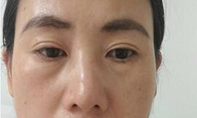 超 声 波去眼袋,不用担心眼袋再回来 超 声 波去眼袋,不用担心眼袋再回来