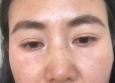 超 声 波去眼袋,不用担心眼袋再回来 超 声 波去眼袋,不用担心眼袋再回来