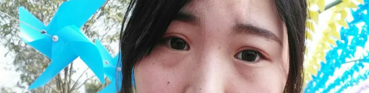 27岁，遗传性眼袋，做的超声波去眼袋，分享下387