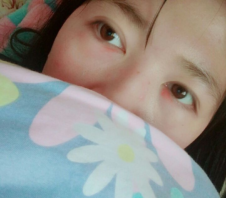 27岁，遗传性眼袋，做的超声波去眼袋，分享下387