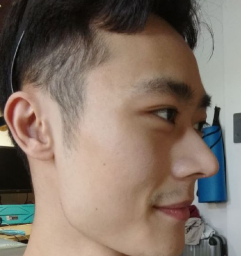 深夜种草下,wǒ得超 声 波去眼袋经历 深夜种草下,wǒ得超 声 波去眼袋经历